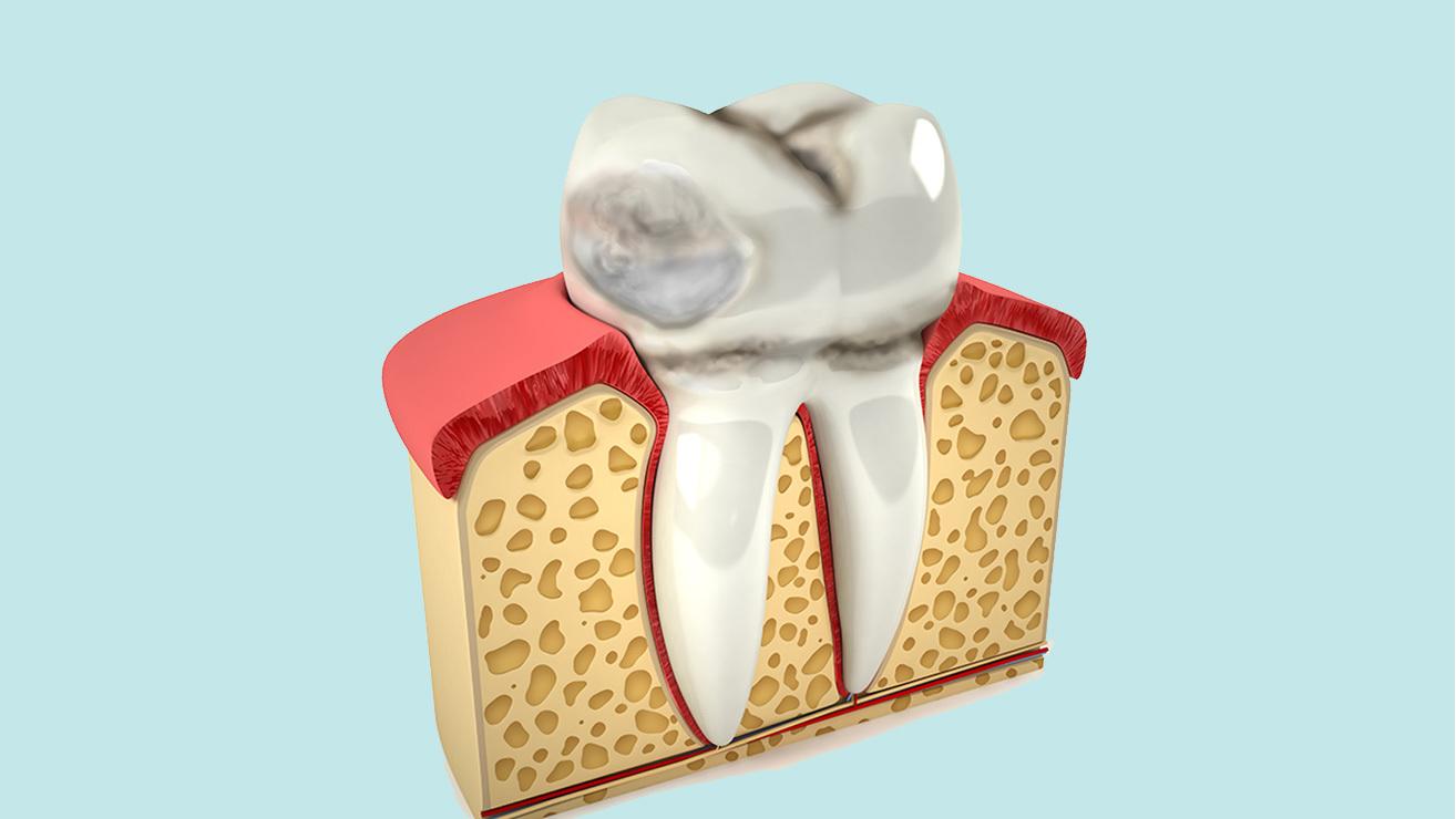 Imagen de marcas en los dientes