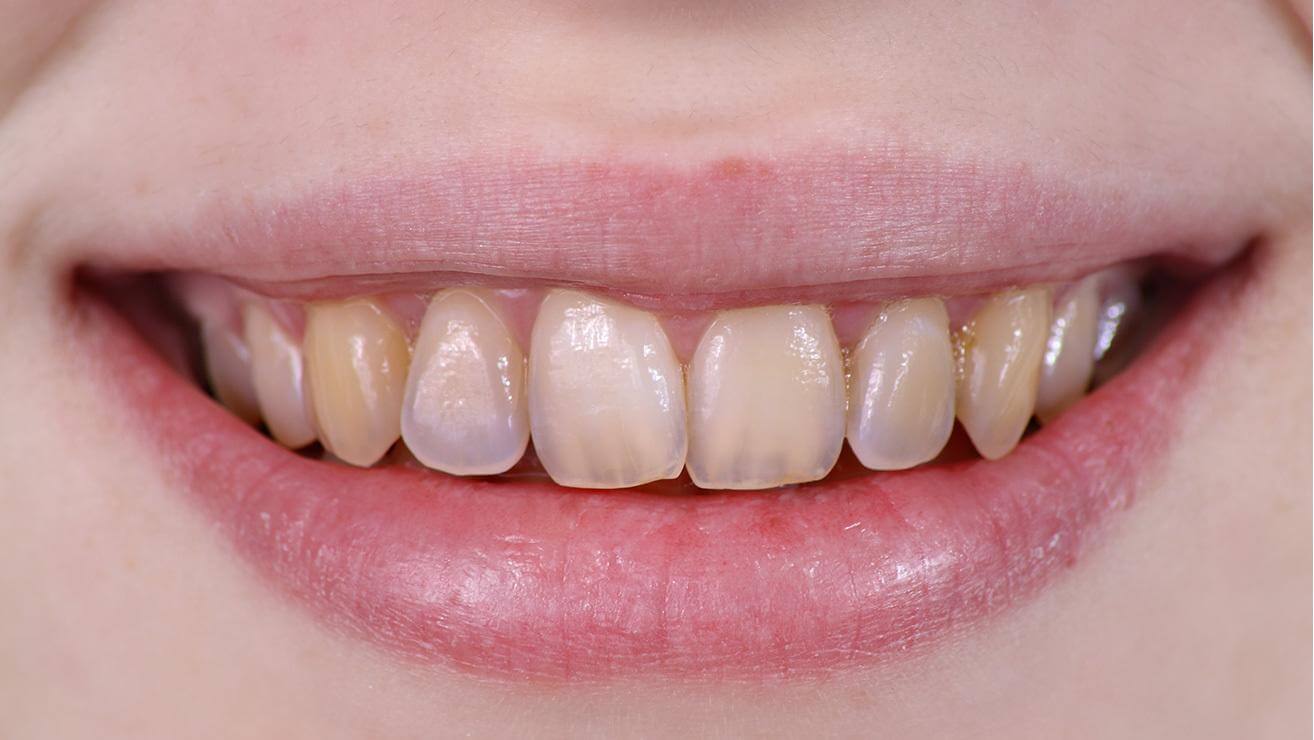 Imagen de dientes amarillentos